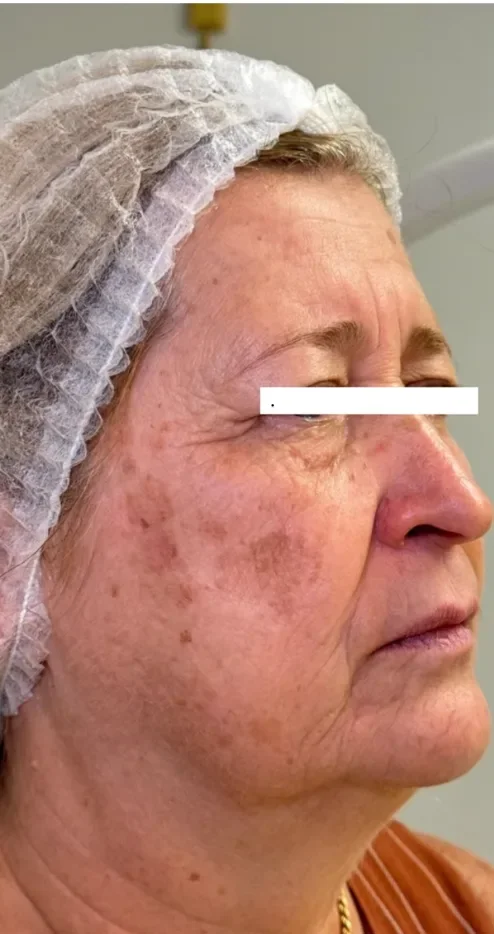 Pele antes do tratamento facial