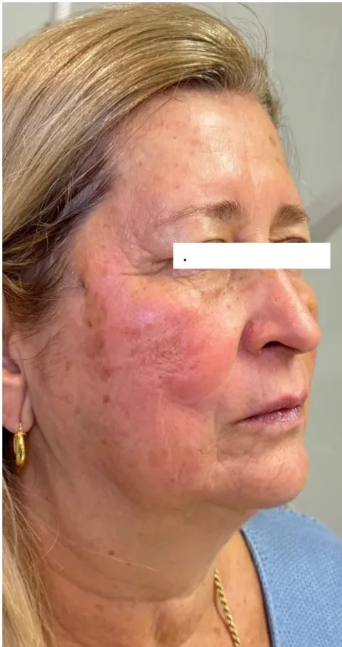 Pele depois do tratamento facial