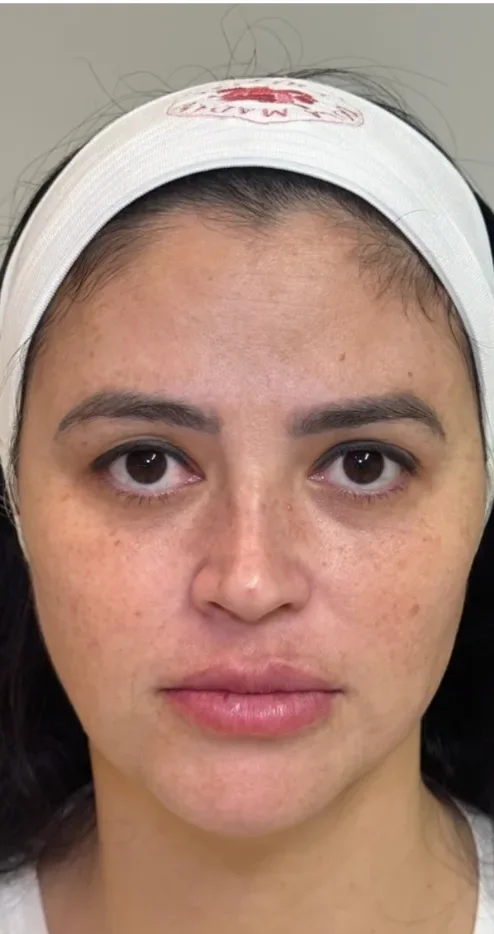 Rosto antes da harmonização facial