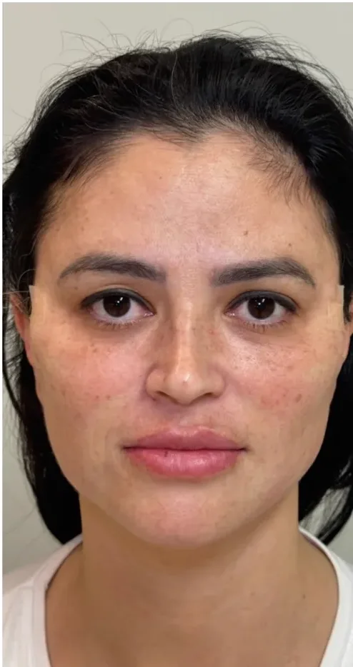 Rosto depois da harmonização facial